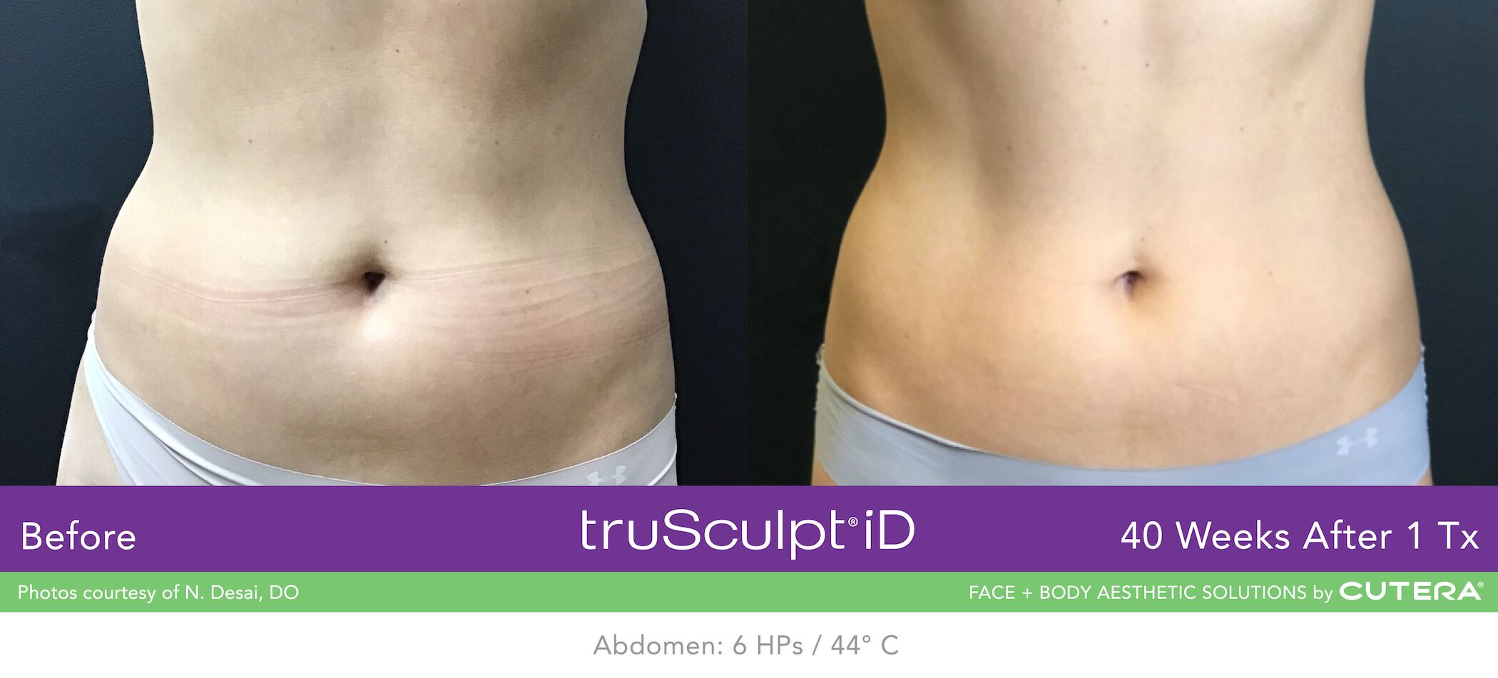 TruSculpt iD For The Flanks New York City - Manhattan - Carnegie Womens  Health